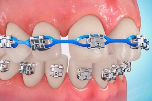 چگونه دندان‌های فاصله‌دار را به کمک ارتودنسی درمان کنیم؟