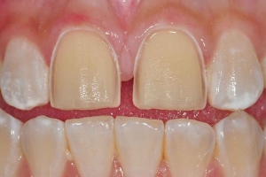 آیا در درمان ارتودنسی مجبور به کشیدن دندان‌ها هستیم؟